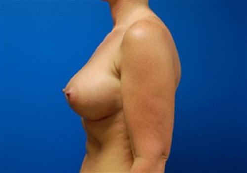 Breast Augmentation Before and After | SGK Plastic Surgery