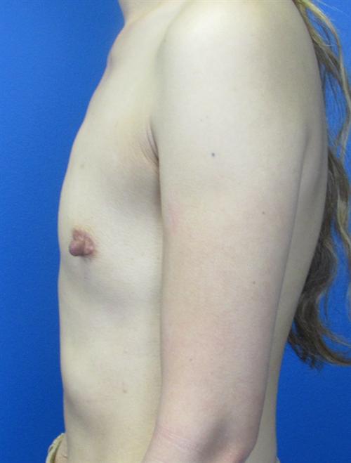 Breast Augmentation Before and After | SGK Plastic Surgery