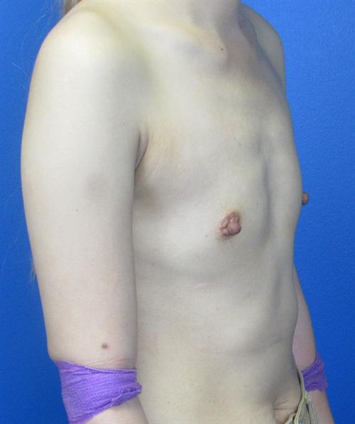 Breast Augmentation Before and After | SGK Plastic Surgery