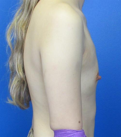 Breast Augmentation Before and After | SGK Plastic Surgery