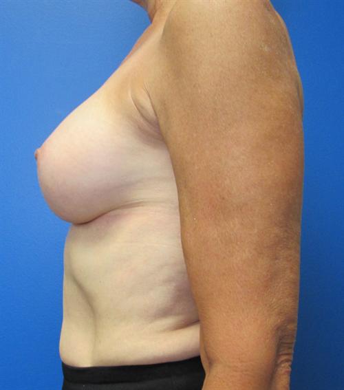 Breast Augmentation Before and After | SGK Plastic Surgery