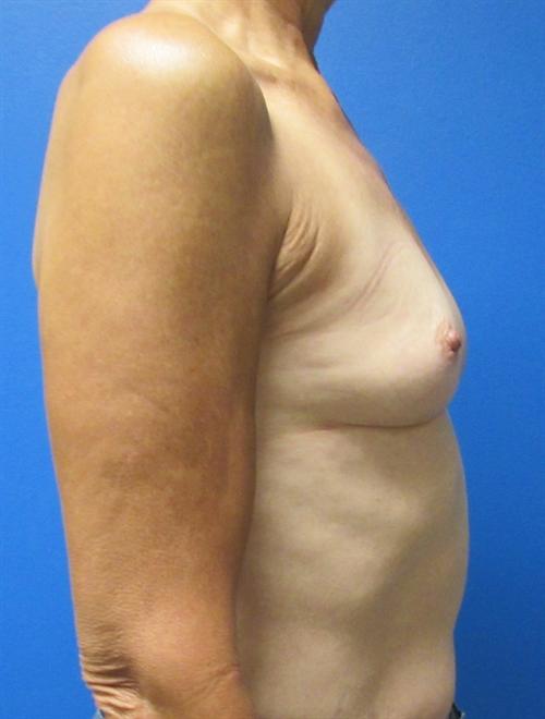 Breast Augmentation Before and After | SGK Plastic Surgery