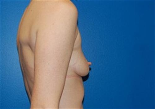 Breast Augmentation Before and After | SGK Plastic Surgery