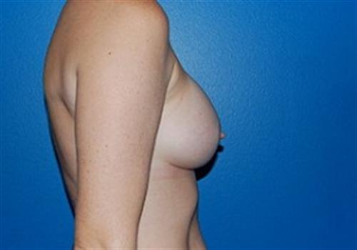 Breast Augmentation Before and After | SGK Plastic Surgery