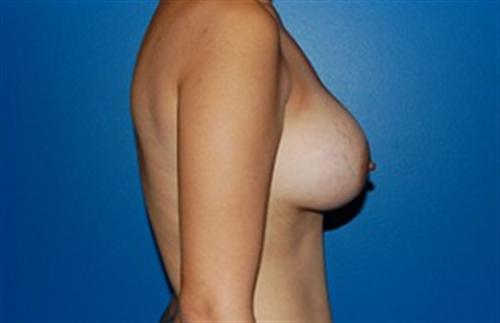 Breast Augmentation Before and After | SGK Plastic Surgery