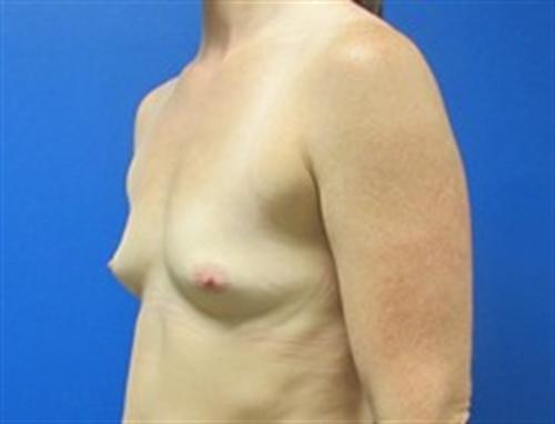 Breast Augmentation Before and After | SGK Plastic Surgery