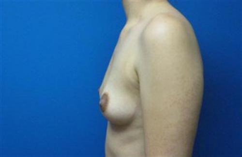 Breast Augmentation Before and After | SGK Plastic Surgery