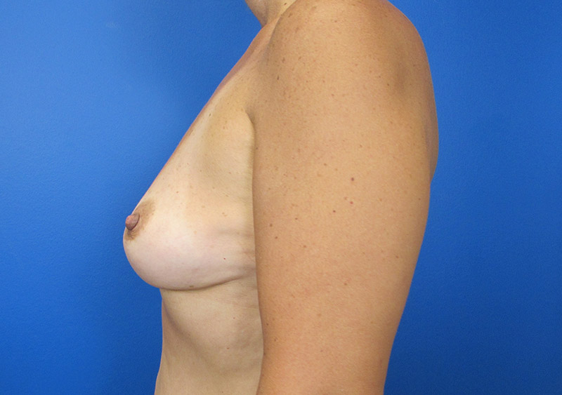 Breast Augmentation Before and After | SGK Plastic Surgery
