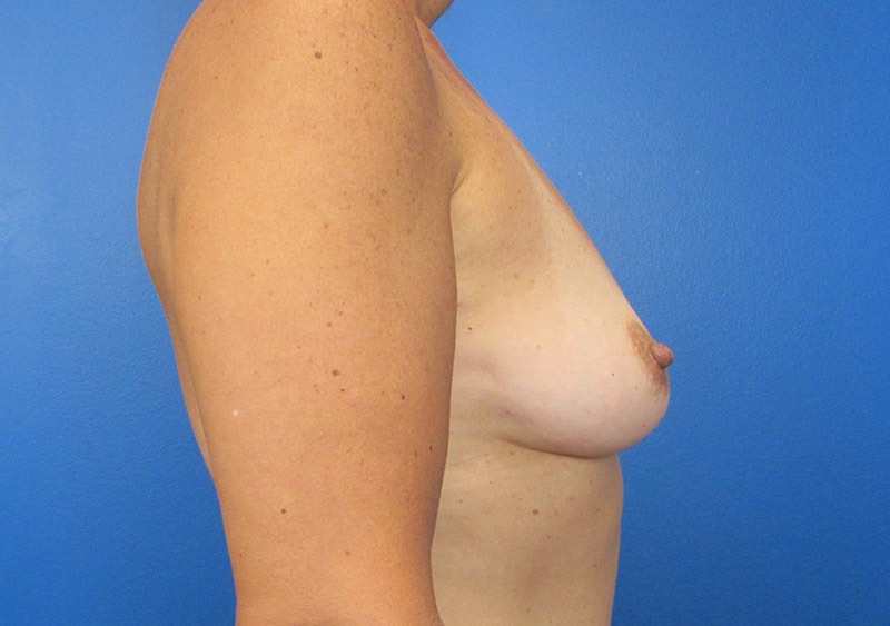 Breast Augmentation Before and After | SGK Plastic Surgery