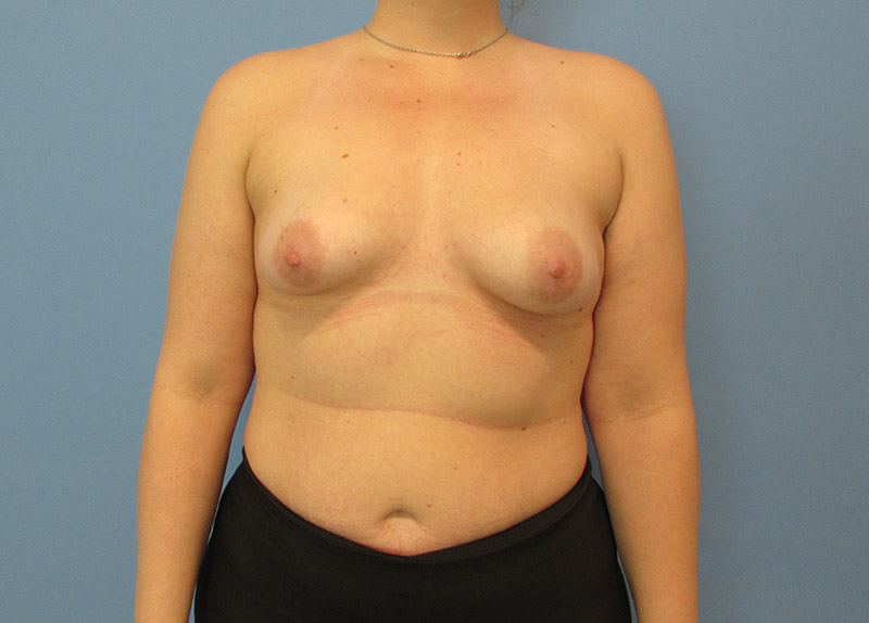 Breast Augmentation Before and After | SGK Plastic Surgery