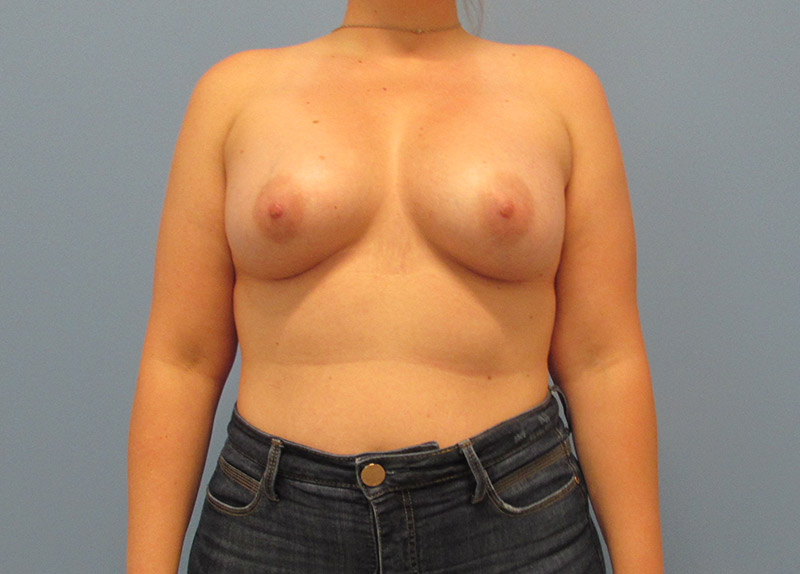 Breast Augmentation Before and After | SGK Plastic Surgery