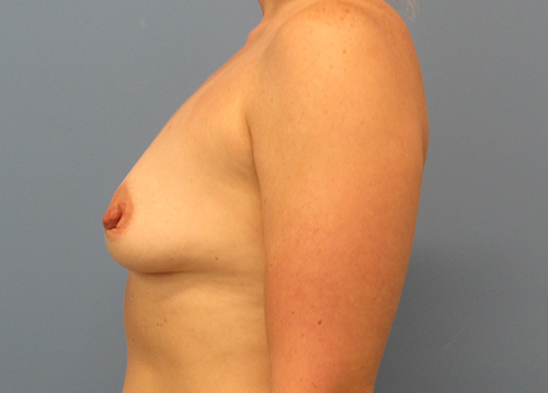 Breast Augmentation Before and After | SGK Plastic Surgery
