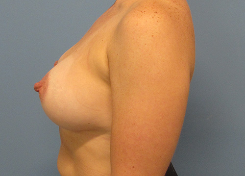 Breast Augmentation Before and After | SGK Plastic Surgery