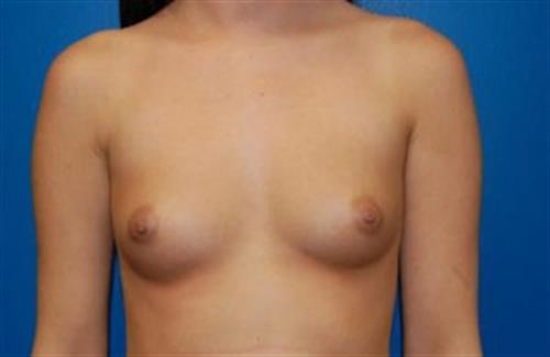 Breast Augmentation Before and After | SGK Plastic Surgery