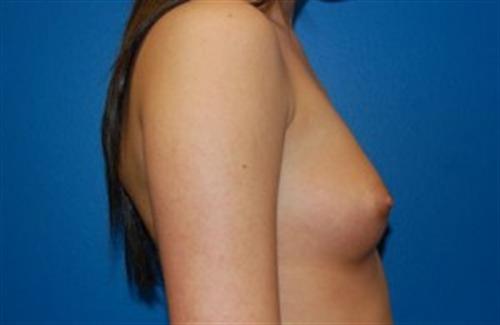 Breast Augmentation Before and After | SGK Plastic Surgery