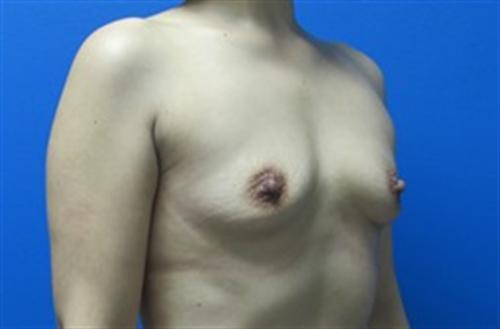 Breast Augmentation Before and After | SGK Plastic Surgery