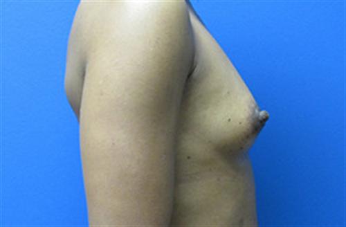 Breast Augmentation Before and After | SGK Plastic Surgery