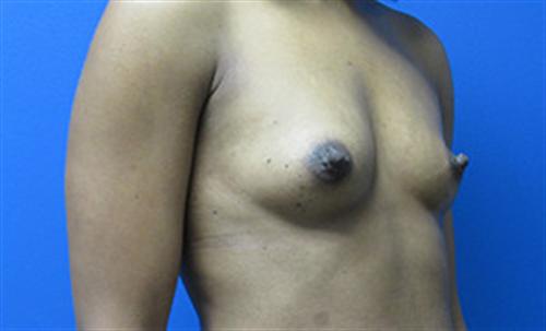 Breast Augmentation Before and After | SGK Plastic Surgery
