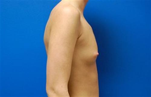 Breast Augmentation Before and After | SGK Plastic Surgery