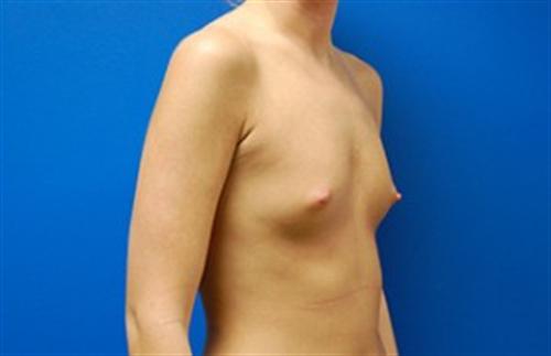 Breast Augmentation Before and After | SGK Plastic Surgery