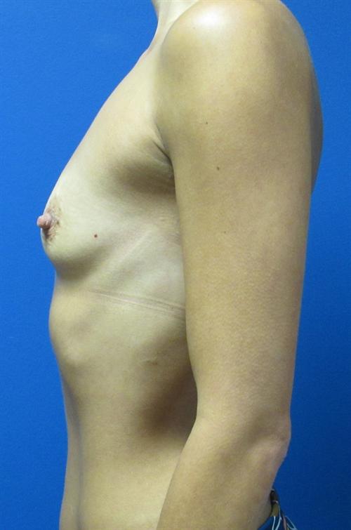 Breast Augmentation Before and After | SGK Plastic Surgery