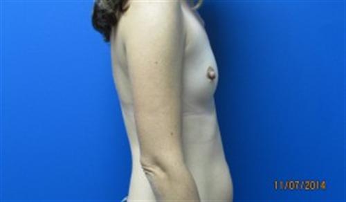 Breast Augmentation Before and After | SGK Plastic Surgery