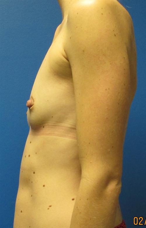 Breast Augmentation Before and After | SGK Plastic Surgery