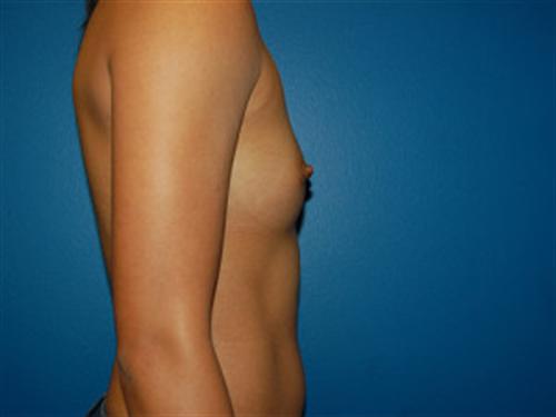 Breast Augmentation Before and After | SGK Plastic Surgery
