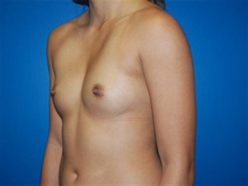 Breast Augmentation Before and After | SGK Plastic Surgery