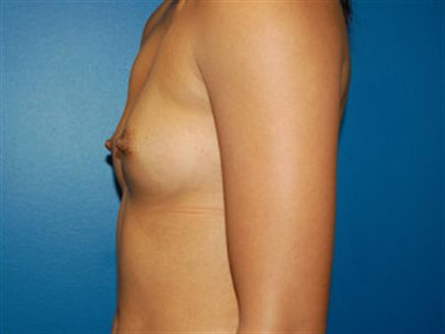 Breast Augmentation Before and After | SGK Plastic Surgery