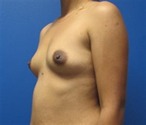 Breast Augmentation Before and After | SGK Plastic Surgery