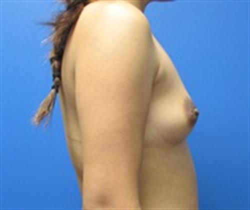 Breast Augmentation Before and After | SGK Plastic Surgery