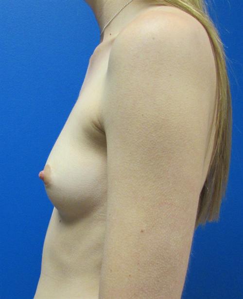 Breast Augmentation Before and After | SGK Plastic Surgery