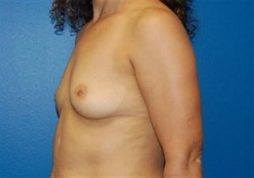 Breast Augmentation Before and After | SGK Plastic Surgery