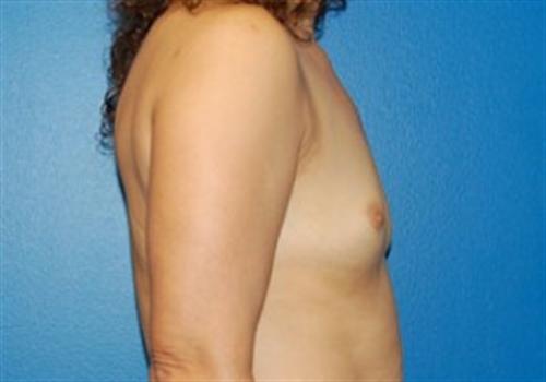 Breast Augmentation Before and After | SGK Plastic Surgery
