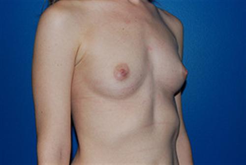 Breast Augmentation Before and After | SGK Plastic Surgery