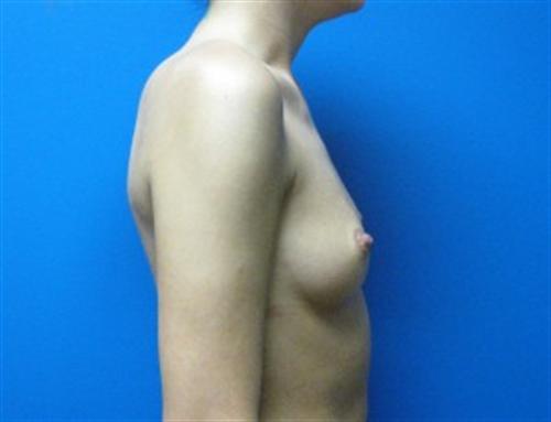 Breast Augmentation Before and After | SGK Plastic Surgery