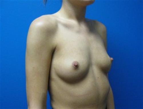 Breast Augmentation Before and After | SGK Plastic Surgery