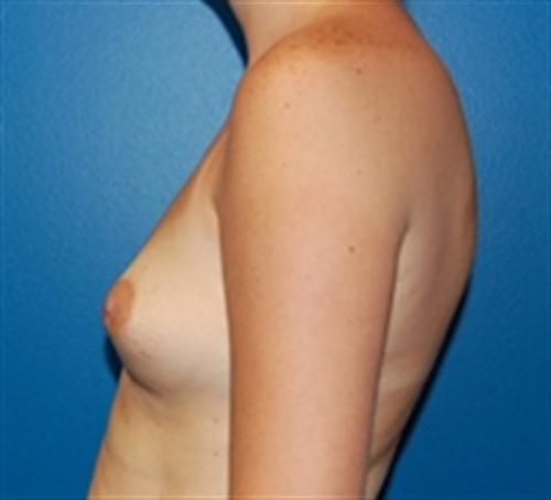 Breast Augmentation Before and After | SGK Plastic Surgery