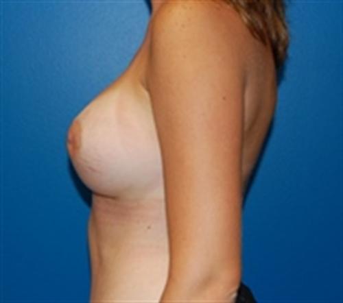 Breast Augmentation Before and After | SGK Plastic Surgery