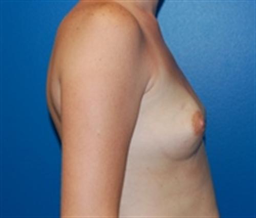 Breast Augmentation Before and After | SGK Plastic Surgery
