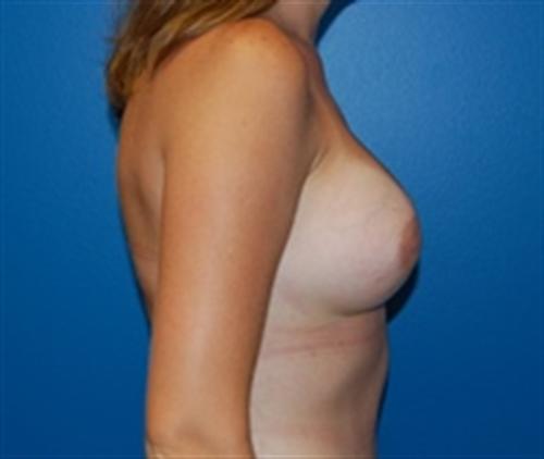 Breast Augmentation Before and After | SGK Plastic Surgery