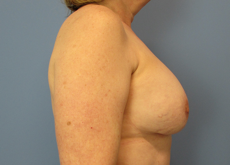 Breast Implant Exchange Before and After | SGK Plastic Surgery