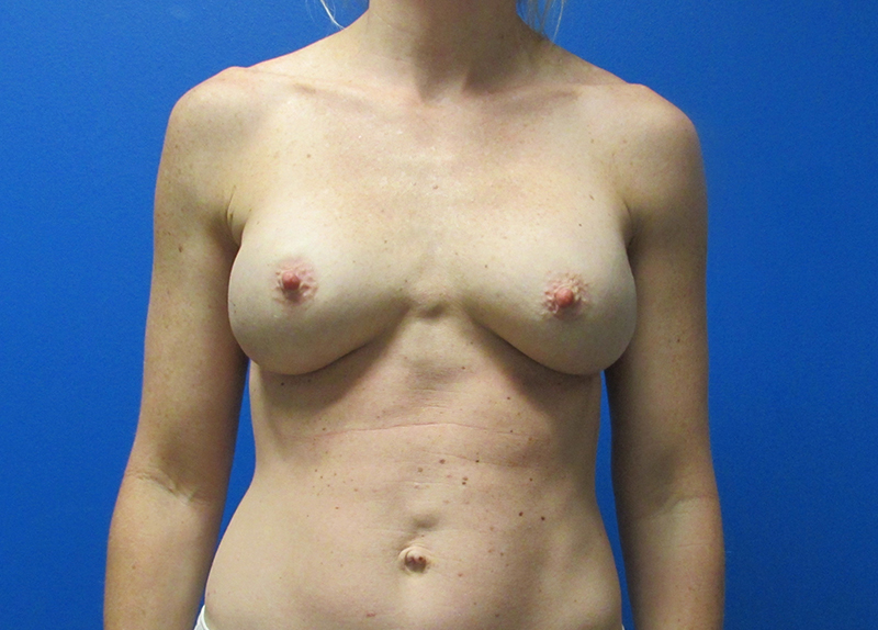 Breast Implant Exchange Before and After | SGK Plastic Surgery