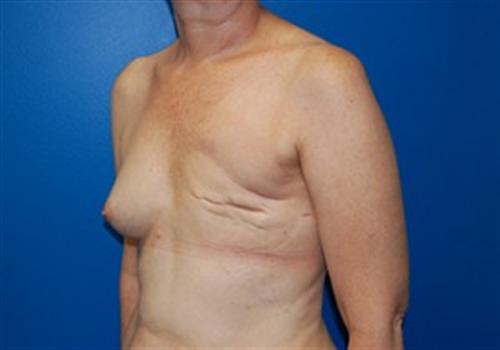 Breast Reconstruction Before and After | SGK Plastic Surgery