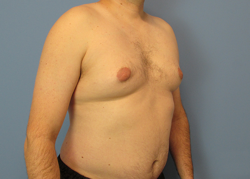 Gynecomastia Before and After | SGK Plastic Surgery