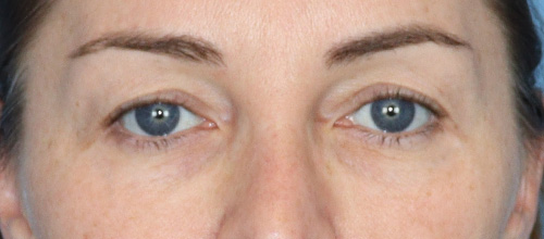 Eyelid Surgery Before and After | SGK Plastic Surgery