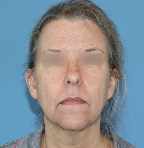 Facelift Surgery in The Woodlands, TX