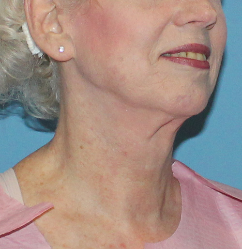 Facelift Before and After | SGK Plastic Surgery