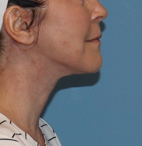 Facelift Before and After | SGK Plastic Surgery